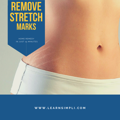 Remove Stretch Marks In Minutes Instantly At Ho
